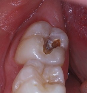 Кариес ("дырка") в зубе. Как обнаружить и зачем нужен рентгеновский снимок? Некариозные поражения. 