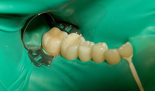 Как понять, что стоматолог-терапевт корректно проводит лечение? Анестезия, изоляция, качество пломбы. 