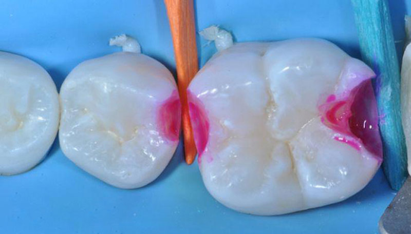 Когда появляются первые постоянные зубы и как обнаружить, созрела ли эмаль на них? 